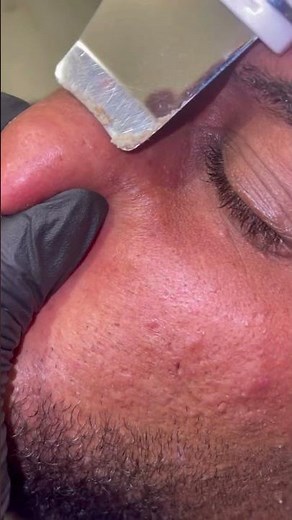 Nose 👃 black heads