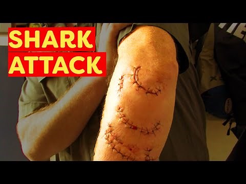 FIRST SHARK ATTACK AT BONDI BEACH IN 80 YEARS