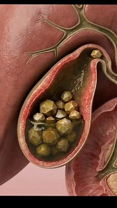 The inflamed, reddened gallbladder is shown filled with numerous faceted, brownish gallstones and thick, greenish bile. A contraction pushes a smaller stone into the cystic duct, where it becomes lodged, causing a visible throbbing and increased swelling of the gallbladder walls. The surrounding liver tissue and bile ducts are also present. | Health IQ Hub