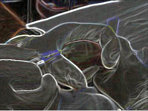 Pediatric IV Tips and Tricks