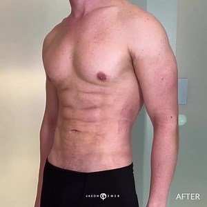 REVISION GLADIATOR LIPO MUSCLE ETCHING