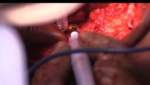 Rectus Femoris Tendon Repair