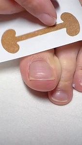 1.7K views · 1.4K reactions | Painful nails? Swelling? Redness?  This Paronychia Corrector is saving nails everywhere! Fast relief • Easy fix • No salon needed  #ParonychiaCorrector #NailPainRelief #NailInfectionCare #ViralReels #USATrending | toecorrector.store | Facebook