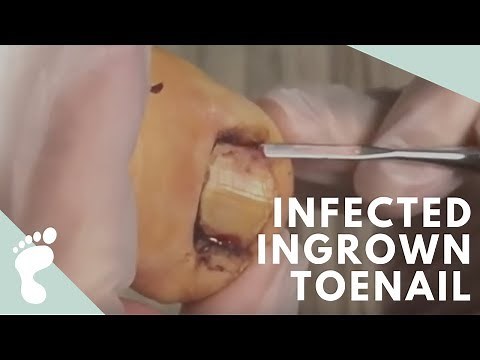 SWOLLEN DOUBLE INFECTED INGROWN TOENAIL