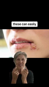 Avoid That Kiss Or Kissing If Someone Has Any Cuts, Sores, Or Open Wounds On Their Face