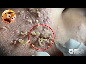 [ASMR] Deep Cleansing Techniques for Glowing Skin and Blackhead Removal 😱😱