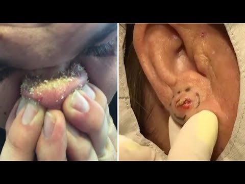HUGE Blackhead Removal - Best Pimple Popping Compilation!