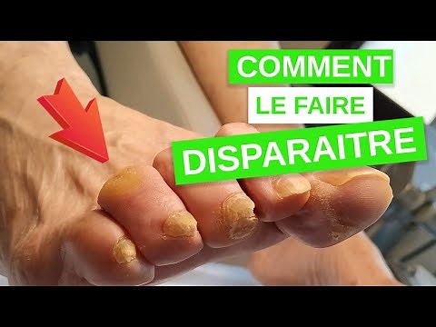 Comment faire disparaître un cor aux pieds ?