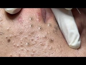 big cystic acne and blackhead removal on lip