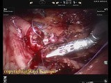 Pediatric Retroperitoneoscopic Robotic Pyeloplasty for Crossing Vessel PUJO • Video • MEDtube.net