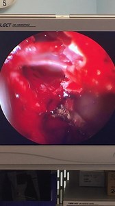 Computerized Sinus Surgery (GRAPHIC)