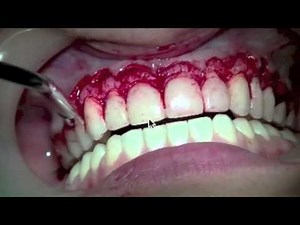 Crown Lenghtening and E-max Veneers • Video • MEDtube.net