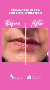 Before and after pictures of a syringe of Revanesse ultra for lips hydration. Plump improving the lines that often appear on the lips, giving you a more defined and natural look. | Natural Beauty Clinic