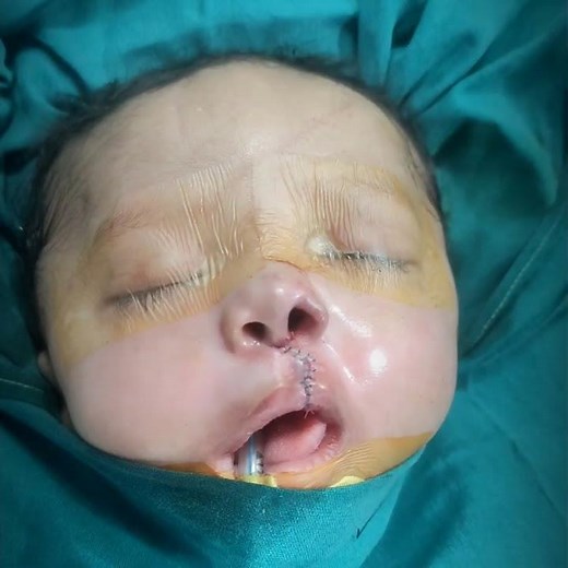 Best Cleft Lip and Nose Repair | Immediate Result After Surgery| Dr Parit Ladani