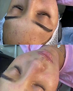 ☀️Aqua peel ☀️ BENEFITS OF THE AQUA PEEL - Allows immediate return to normal activities (no downtime) - Visible results after first treatment with lasting, more significant results after 4 to 6 treatments - Versatile system beneficial for Acne Problems, Skin Congestion, Dull and Ageing Skin, Dehydrated Skin, Fine Lines, Sensitive Skin By: @hebafawzymakeupartist For more details and reservations Call : 01095275000 | Lavish | Facebook