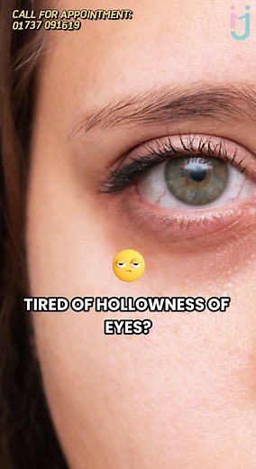 17K views · 74 reactions | Dermal Filler Treatment For Under Eye Hollows  #dermalfillertreatment #eyehollow #eyehollowness #eyehollowprocedure #HealthySkinCare | Dr. Israt Jahan | Facebook