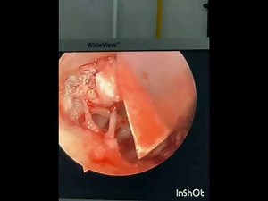 Endoscopic Cholesteatoma surgery& reconstruction; step by step 😎