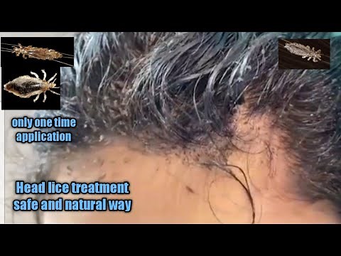 Head lice treatment safe and natural way/kuto removal/home remedy /remove head lice in a single day