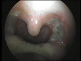 Post- Tonsillectomy Tonsillar Bed Sloughs  • Video • MEDtube.net