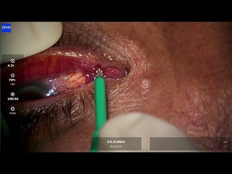 Perforated Plug for Punctal Stenosis, Dr.Numan KÜÇÜK