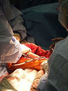 Bone grafting - Alchetron, The Free Social Encyclopedia