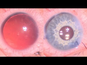 Artificial iris and intraocular lens in the bag implantation in patient with congenital aniridia