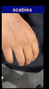 386K views · 3.8K reactions | #Scabies #dermatology #doctors | Jitendra Kumawat | Facebook
