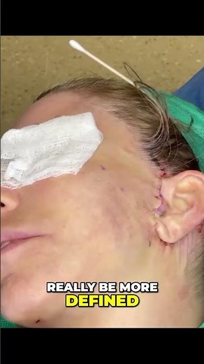 Advanced Facelift: SMAS & Deep Plane Dissection Technique