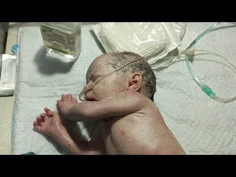 Cleaning Amniotic Fluid with Liquid Paraffin from newborn & Cord Clamp Replacement 👶🧼