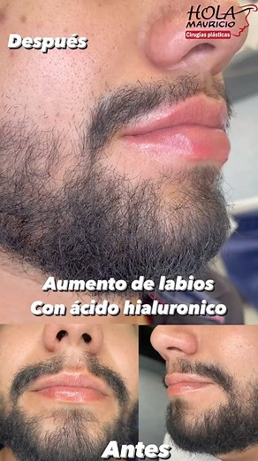 Aumento de labios con Ácido Hialurónico: La técnica consiste en inyectar ácido hialurónico en los labios para aumentar su grosor, para destacar el perfilado y para elevar las comisuras. Agenda tu consulta gratis #0990916911 | Hola Mauricio Cirugías Plásticas