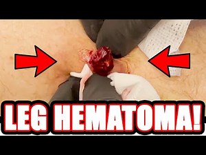 LEG HEMATOMA!