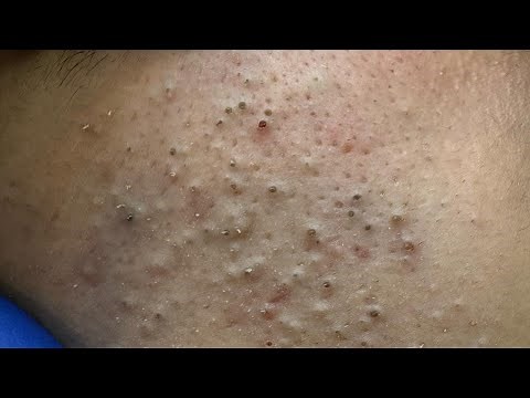 Satisfying Blackhead Removals & Deep Cleansing Techniques | ASMR
