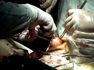 Gout (Uric Acid) Tophy Removal / Surgery