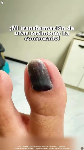 ZKY-ZJY81-Onicomicosis (infección por hongos en las uñas). ¡Tienes que probar esto!