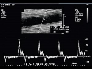 Upper Extremity Arterial Doppler Study(UEA practical protocol).