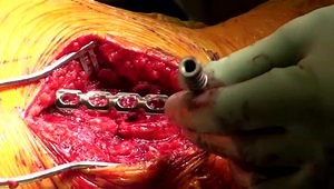 Spine Scapular Fracture Non-union ORIF Solution