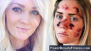 Cloques Sur La Peau Du Visage 💪💪 Tout À Propos Des Modes De Vie Sains Et De Remise En Forme - 2025