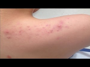 how to get rid of acne on arms and shoulders