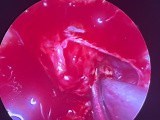 Endoscopic Resection of Microadenoma in Acromegaly: Medial Cavernous Wall Challenge • Video • MEDtube.net