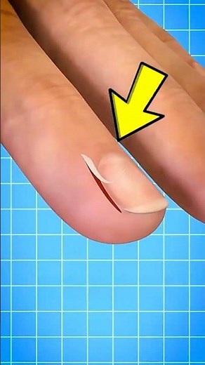 “The Right Way to Fix a Painful Hangnail, Do This Before It Hurts!”