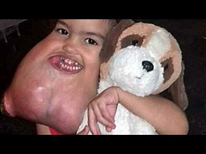 Surgeons Remove 3 Yr Old Girl’s Giant Facial Tumor