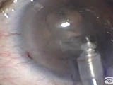 Snap and Split Phaco Technique - Eyetube