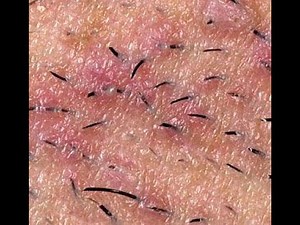Removing Ingrown Hairs Hair - Eruptive Vellus Hair Cysts
