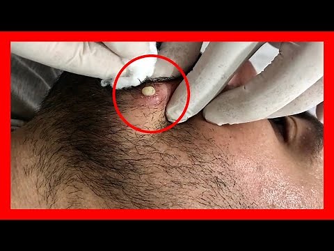 EXPLOTANDO Granos y ESPINILLAS De La Cara 🌋