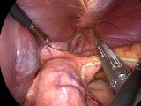 Wedge Gastrectomy for Subcardial GIST • Video • MEDtube.net