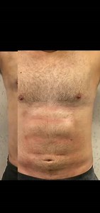 High-Definition VASER Liposuction! #six-packabdomen #lymphaticfacialmassagehouston #bestlymphaticmassagehouston #bestlymphaticmassage #drenajelinfáticohouston #posopcare | Victoria Heavenly Spa