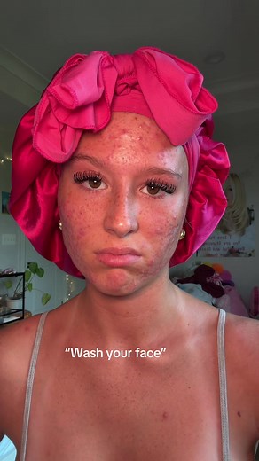 Skincare Tips for Girls with Acne: Drink Water, Wash Face, Take Acne Meds