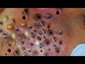 Deep Cyst & Pus Explosion | Unbelievable Pimple Popping 🤯 | Acne Scars Treatment