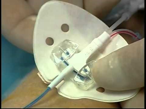 Bard Medical STATLOCK® PICC Plus Stabilisation Device YouTube2