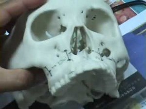 LeFort I Maxillary Osteotomy for Orthognathic surgery - Instruction I